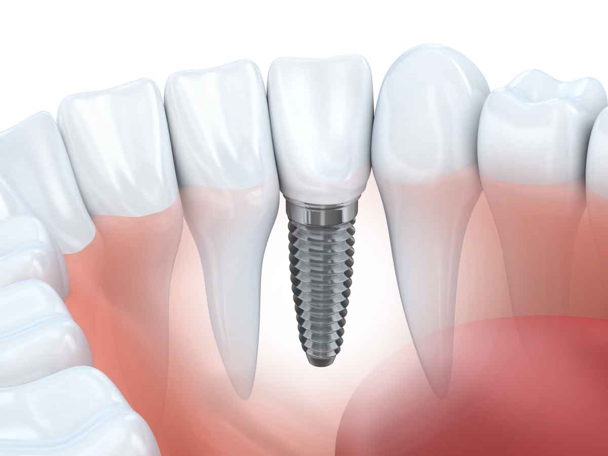 Dental Implants