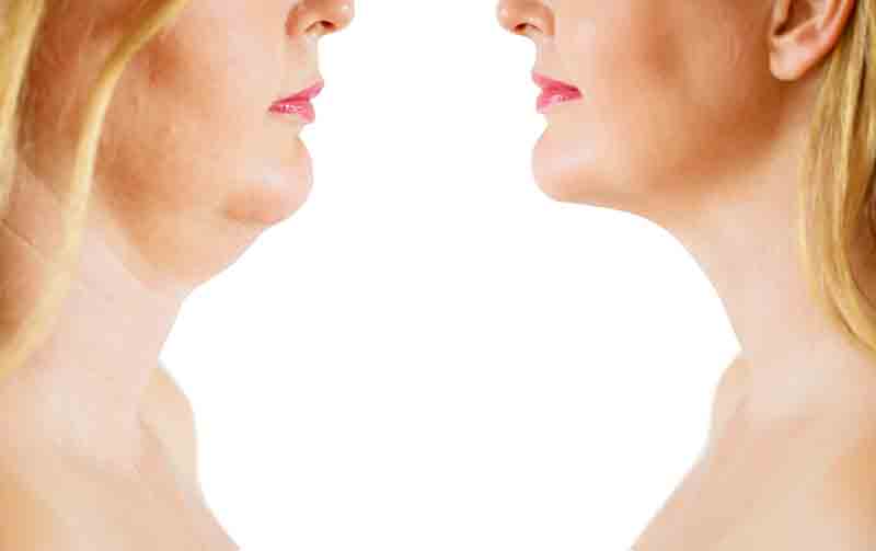 KYBELLA® KYBELLA®