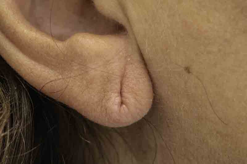 Earlobe Reduction Earlobe Reduction