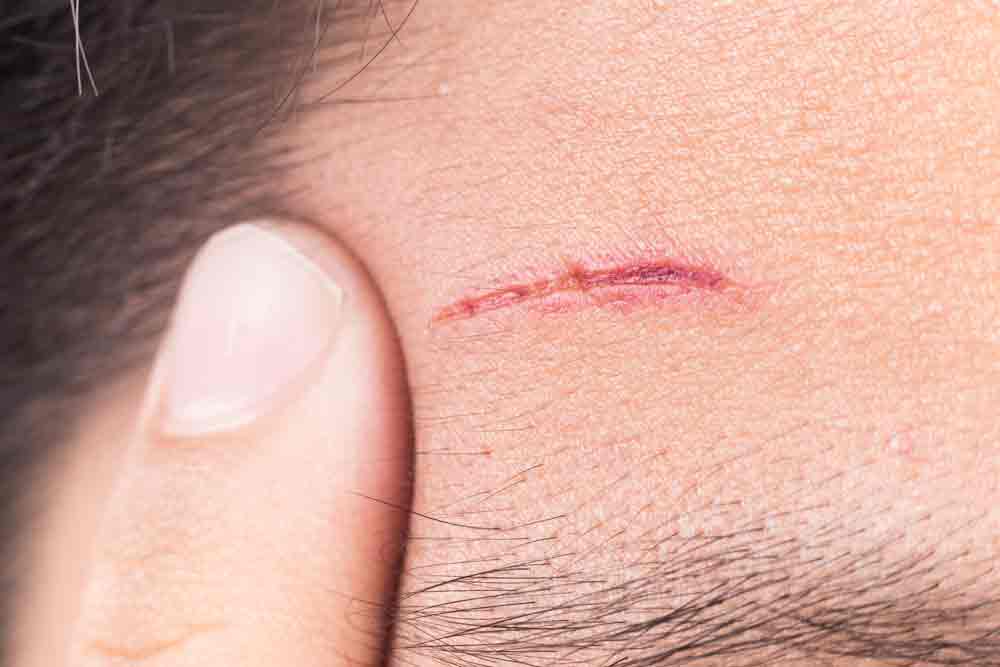 Scar Removal And Revision Scar Removal And Revision