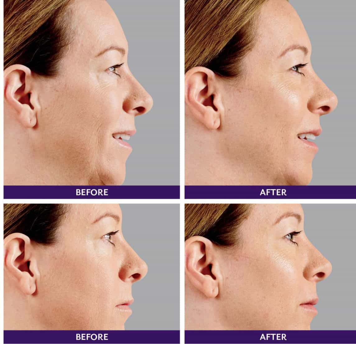 Injectable Filler Injectable Filler
