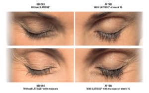 Brow Lift