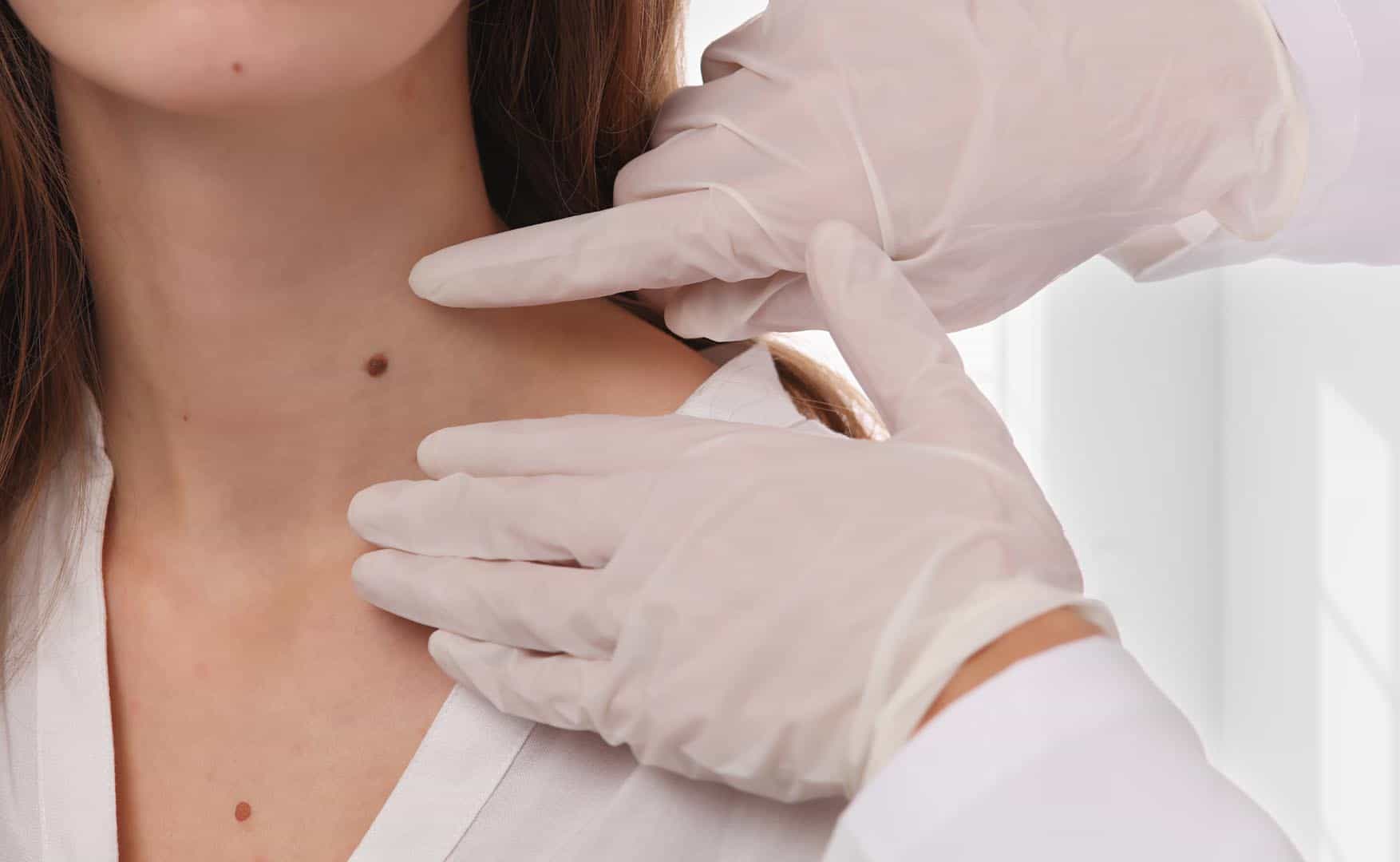 Mole Removal Mole Removal