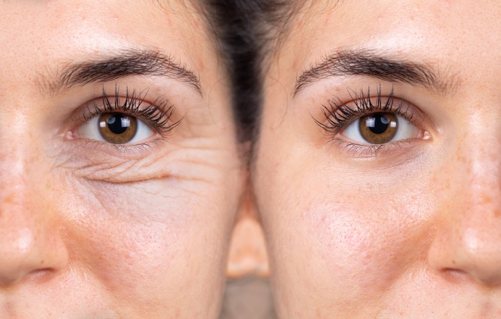 Blepharoplasty Blepharoplasty
