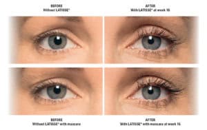 Brow Lift