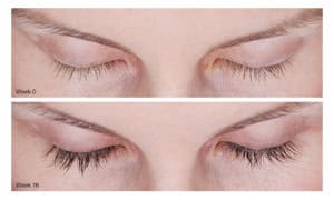 Brow Lift