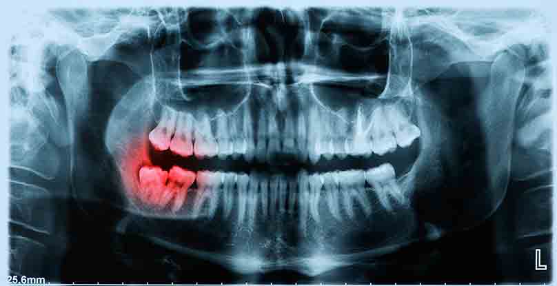 Impacted Teeth Removal