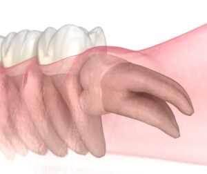 horizontal impaction of wisdom tooth. medically accurate tooth 3d illustration