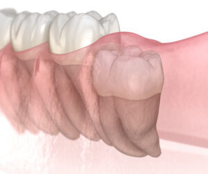 vertical impaction of wisdom tooth. medically accurate tooth 3d illustration