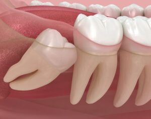 abnormal position of wisdom teeth. medically accurate tooth 3d illustration