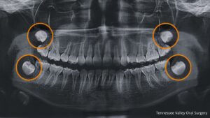 what are wisdom teeth